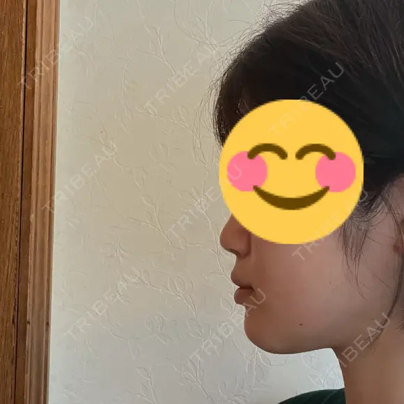 ヒアルロン酸注入（あご） ヴェリテクリニック 大阪院 AFTER メイン用