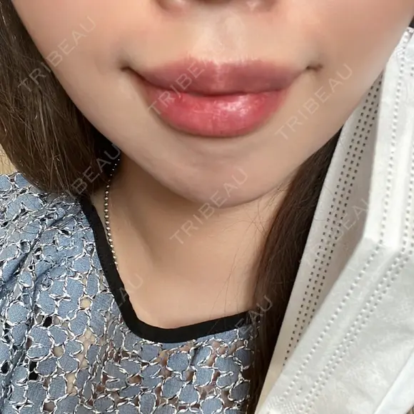 ヒアルロン酸注入（唇） / ボトックス（口角） 東京美容外科 熊本院 DAY 3 メイン用