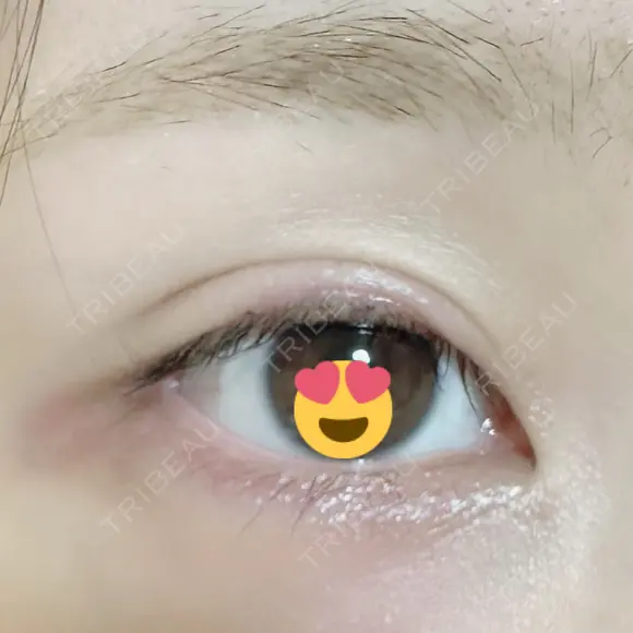 その他（目元） グリシーヌクリニック AFTER メイン用