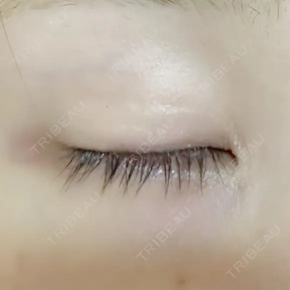 その他（目元） グリシーヌクリニック DAY 11 メイン用