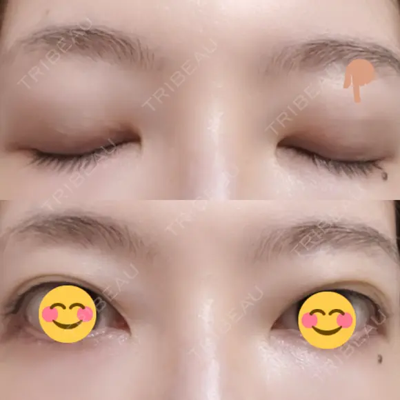 二重埋没 / 上まぶたの脂肪取り THE FIRST CLINIC 多摩センター院 DAY 26 メイン用
