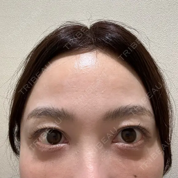 クマ治療 / スネコス PRISM Beauty Clinic 町田院 DAY 1 メイン用