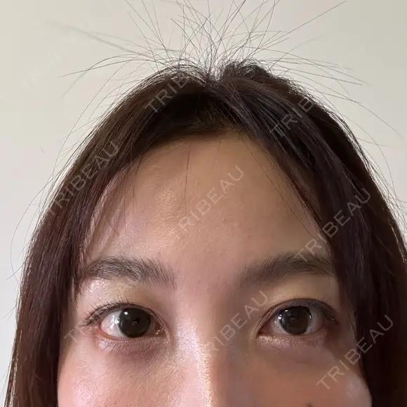 クマ治療 / スネコス PRISM Beauty Clinic 町田院 DAY 3 メイン用