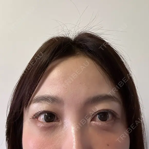 クマ治療 / スネコス PRISM Beauty Clinic 町田院 DAY 4 メイン用
