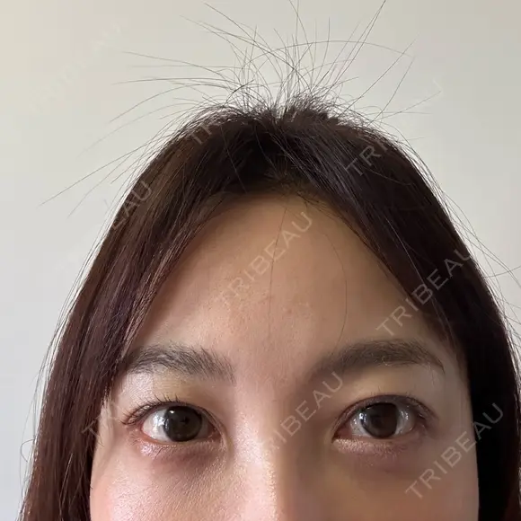 クマ治療 / スネコス PRISM Beauty Clinic 町田院 DAY 5 メイン用