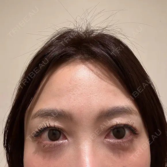 クマ治療 / スネコス PRISM Beauty Clinic 町田院 DAY 6 メイン用