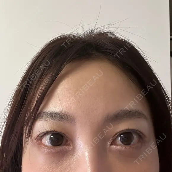 クマ治療 / スネコス PRISM Beauty Clinic 町田院 DAY 7 メイン用