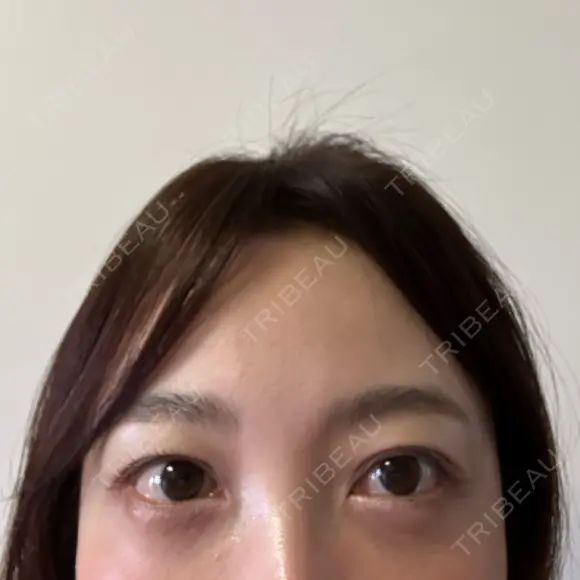 クマ治療 / スネコス PRISM Beauty Clinic 町田院 DAY 8 メイン用