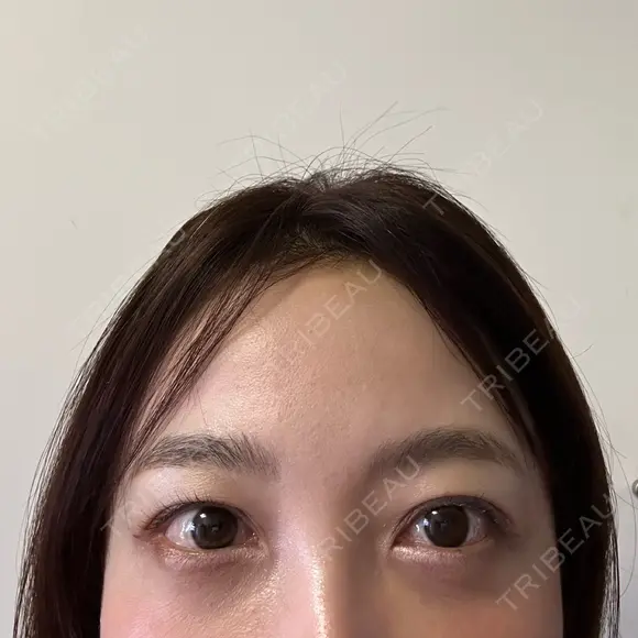 クマ治療 / スネコス PRISM Beauty Clinic 町田院 AFTER メイン用