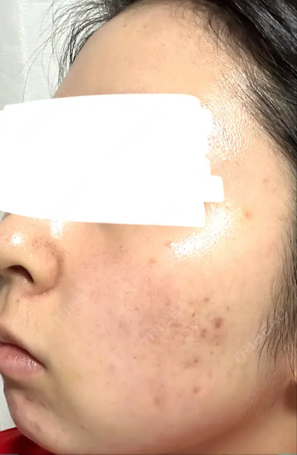 水光注射（ハリ・美肌） ARTE BEAUTY CLINIC DAY 6 メイン用