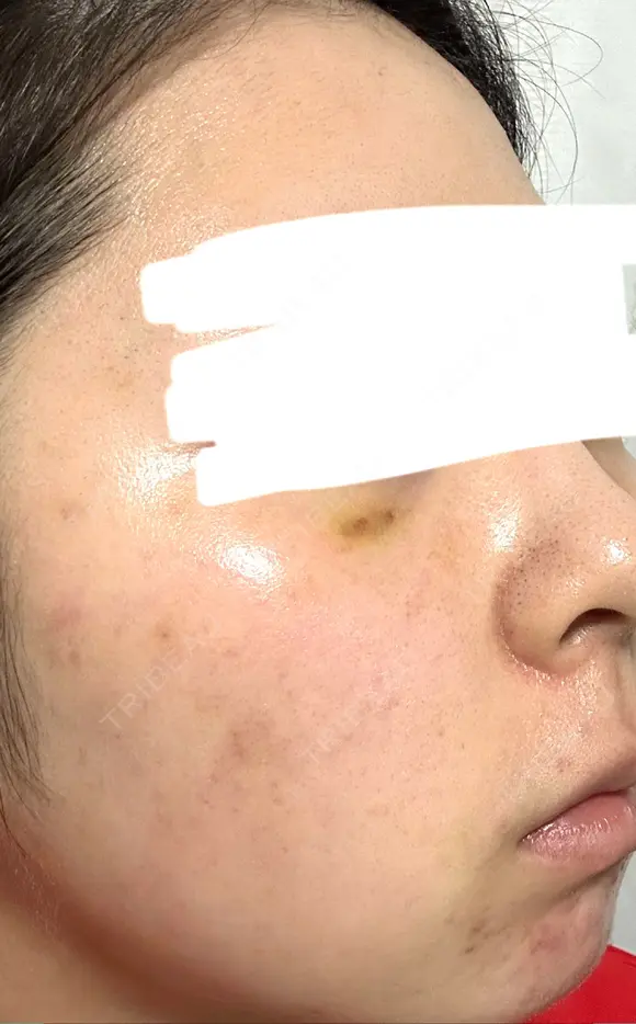 水光注射（ハリ・美肌） ARTE BEAUTY CLINIC DAY 6 メイン用