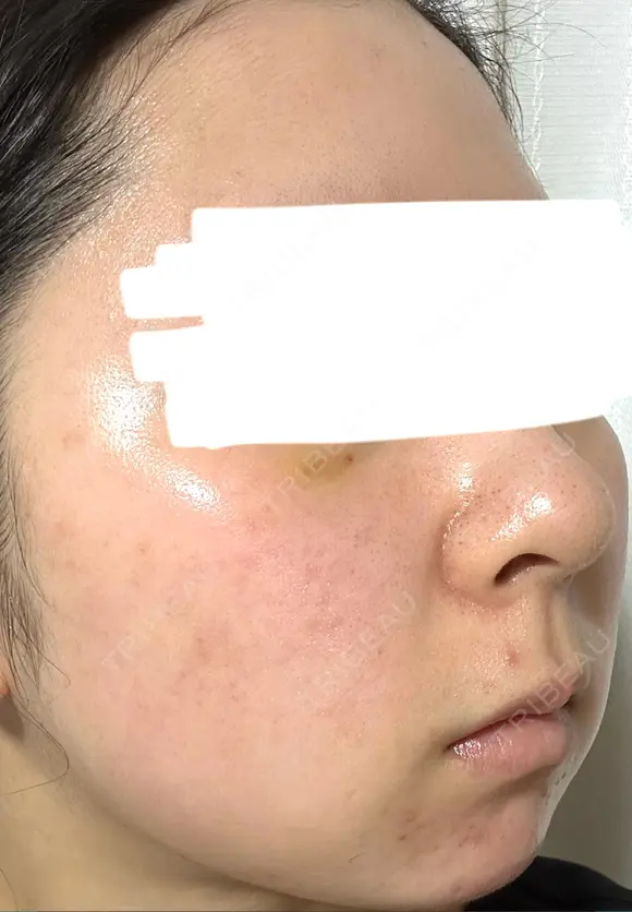 水光注射（ハリ・美肌） ARTE BEAUTY CLINIC DAY 7 メイン用