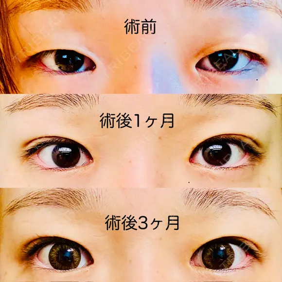 目頭切開 / 自然癒着法 / 眼瞼下垂（非切開） LUHO（ルホ）美容外科 DAY 91 メイン用
