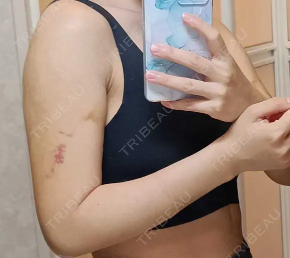 脂肪吸引（二の腕） アムルーズ美容外科クリニック 大阪院 DAY 14 メイン用
