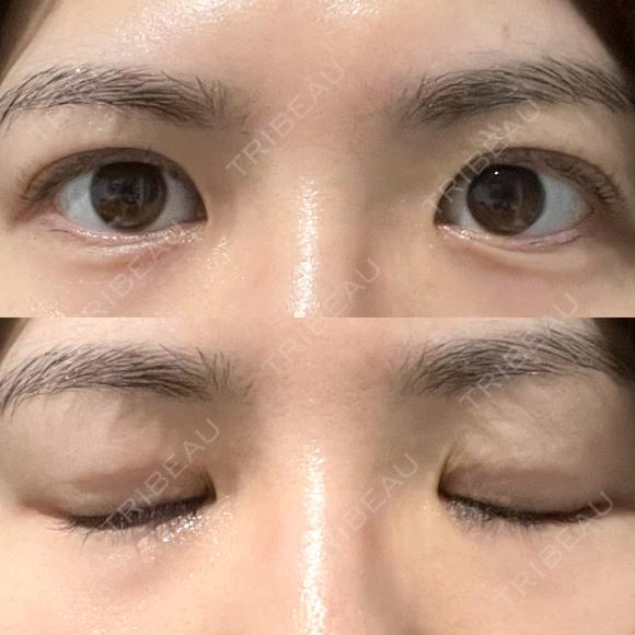 その他（目元） / 自然癒着法 LUHO（ルホ）美容外科 DAY 93 メイン用