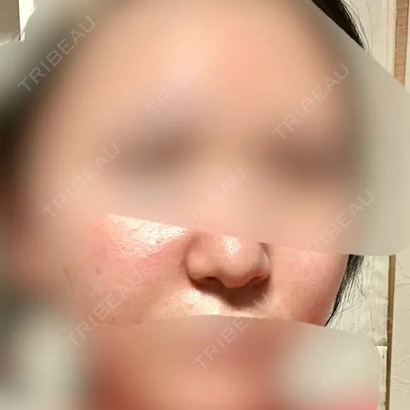 脂肪溶解注射（顔） / ヒアルロン酸注入（鼻翼基部） SK新宿歌舞伎町美容外科・歯科 AFTER メイン用