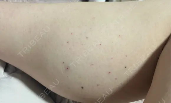 ボトックス（ふくらはぎ） ビューティースキンクリニック 池袋院 DAY 0 メイン用