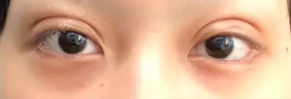 二重埋没 恵聖会クリニック 心斎橋院 DAY 0 メイン用