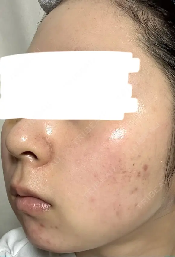 水光注射（ハリ・美肌） ARTE BEAUTY CLINIC DAY 8 メイン用