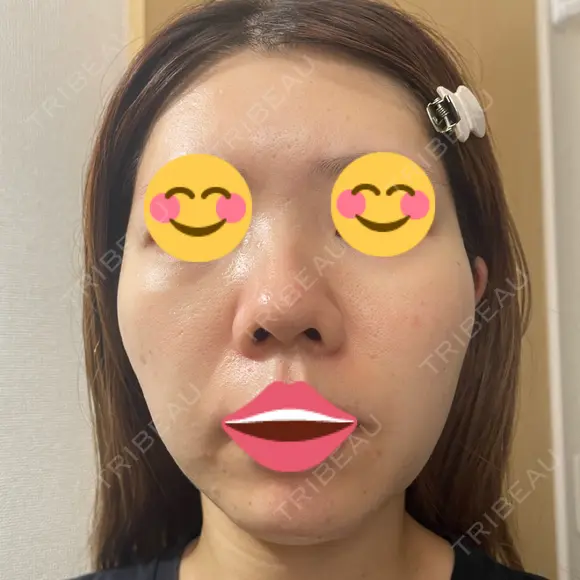 ポテンツァ DAILY SKIN CLINIC 福岡院 DAY 4 メイン用