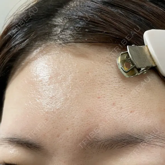 ポテンツァ DAILY SKIN CLINIC 福岡院 DAY 4 メイン用