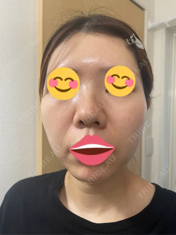 ポテンツァ DAILY SKIN CLINIC 福岡院 DAY 5 メイン用