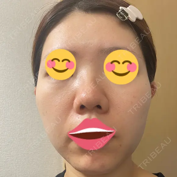 ポテンツァ DAILY SKIN CLINIC 福岡院 DAY 7 メイン用