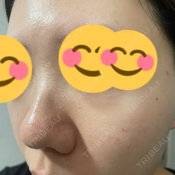 ポテンツァ DAILY SKIN CLINIC 福岡院 DAY 7 メイン用
