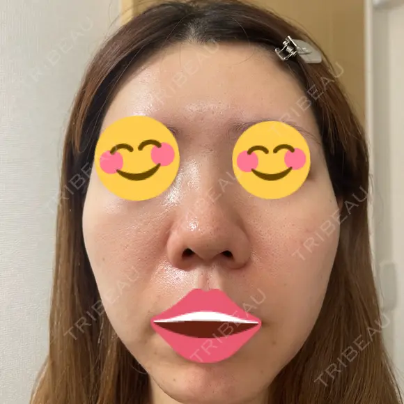 ポテンツァ DAILY SKIN CLINIC 福岡院 DAY 8 メイン用