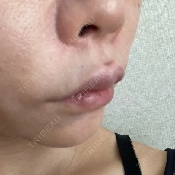 ヒアルロン酸注入（唇） ルラ美容クリニック 大宮院 / ルラスキンクリニック 大宮院 DAY 7 メイン用