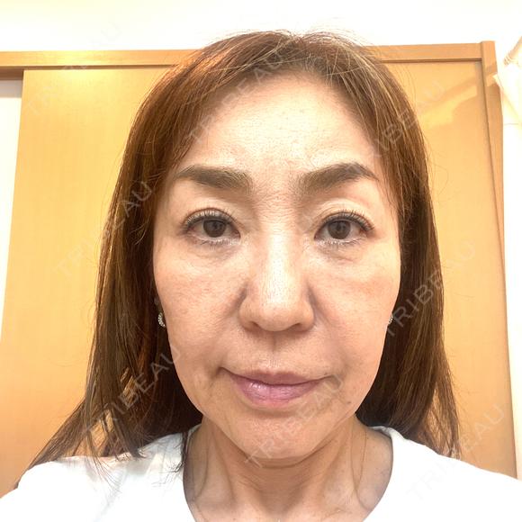 ボトックス（あご） / ボトックス（口角） / ボトックス（眉間） / ボトックス（額） TCB東京中央美容外科 自由が丘院 DAY 0 メイン用