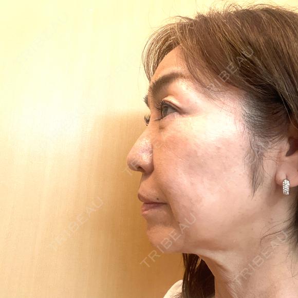 ボトックス（あご） / ボトックス（口角） / ボトックス（眉間） / ボトックス（額） TCB東京中央美容外科 自由が丘院 DAY 0 メイン用