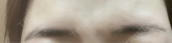 ボトックス（あご） / ボトックス（肩） / ワキ汗治療（ボトックス） / ボトックス（眉間） 共立美容外科 名古屋院 DAY 3 メイン用