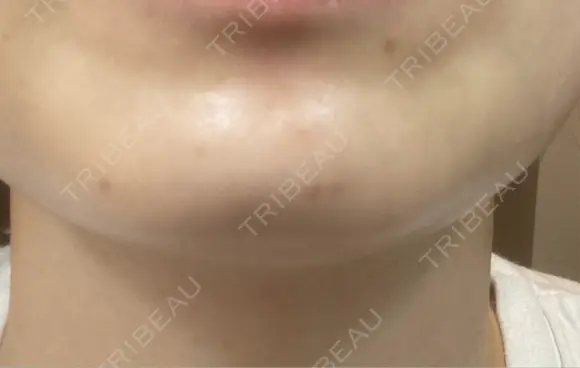 ボトックス（あご） / ボトックス（肩） / ワキ汗治療（ボトックス） / ボトックス（眉間） 共立美容外科 名古屋院 DAY 3 メイン用