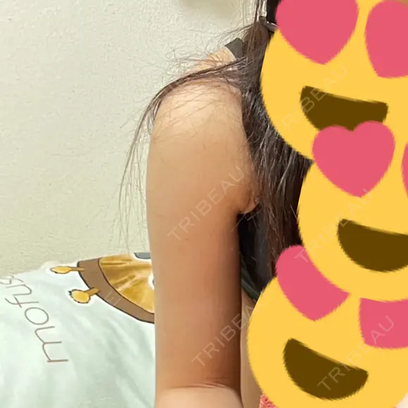 脂肪吸引（二の腕） アムルーズ美容外科クリニック 横浜院 DAY 35 メイン用
