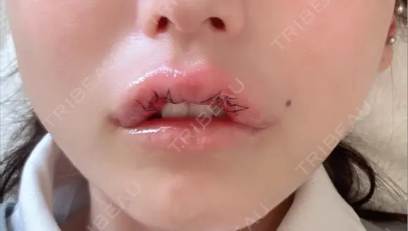 その他（口元） アネシス美容クリニック DAY 2 メイン用