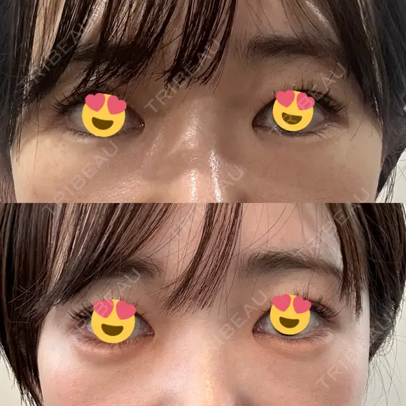 ヒアルロン酸注入（涙袋） / ヒアルロン酸注入（唇） / ボトックス（人中） HAAB×DREAM BEAUTY CLINIC 東京本院 DAY 1 メイン用