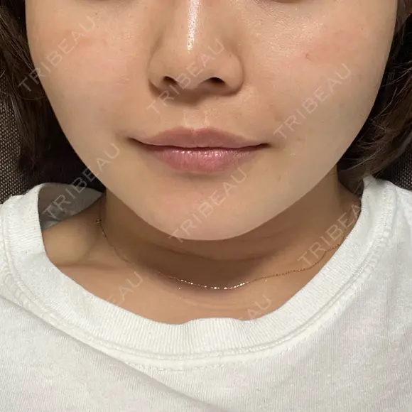 糸リフト / 脂肪吸引（顔） / ヒアルロン酸注入（唇） 仙台TAクリニック AFTER メイン用