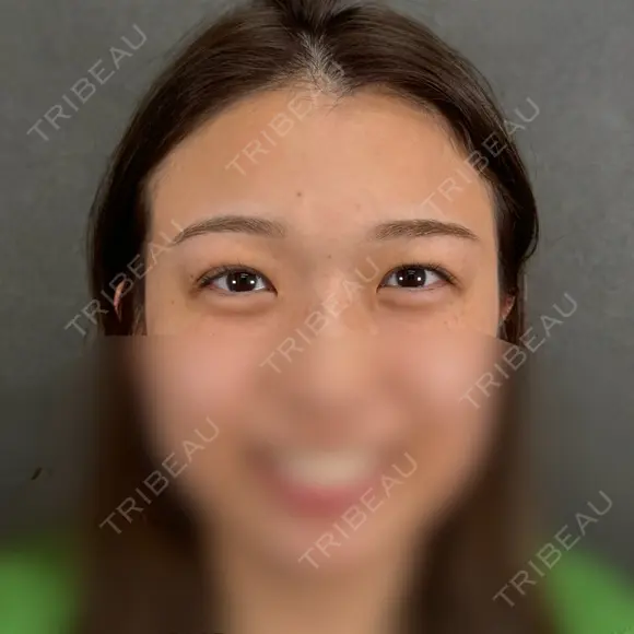 二重埋没 ネビュラクリニック 京都院 AFTER メイン用