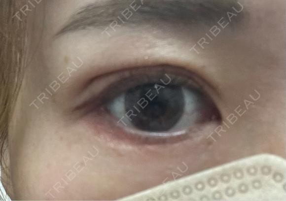 二重埋没 吉祥寺アイビークリニック AFTER メイン用