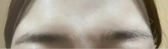 ボトックス（あご） / ボトックス（肩） / ワキ汗治療（ボトックス） / ボトックス（眉間） 共立美容外科 名古屋院 AFTER メイン用