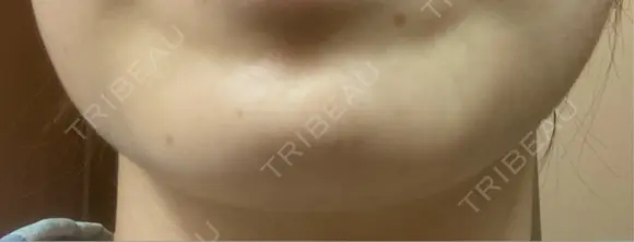 ボトックス（あご） / ボトックス（肩） / ワキ汗治療（ボトックス） / ボトックス（眉間） 共立美容外科 名古屋院 DAY 7 メイン用