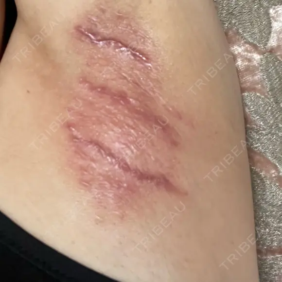 ワキ汗治療（切開） 石倉クリニック 水戸院 AFTER メイン用