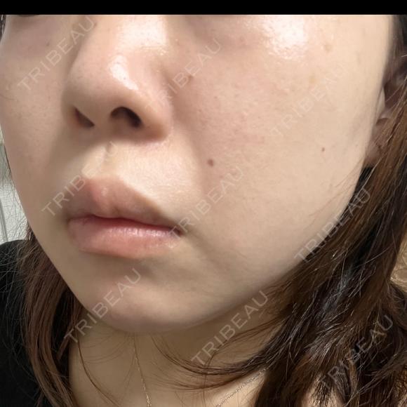 エレクトロポレーション / ルメッカ B-LINE CLINIC 池袋院 DAY 6 メイン用