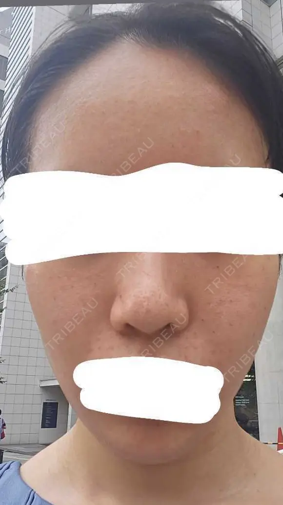 水光注射（ハリ・美肌） RAISE CLINIC 【レイズクリニック】 DAY 0 メイン用