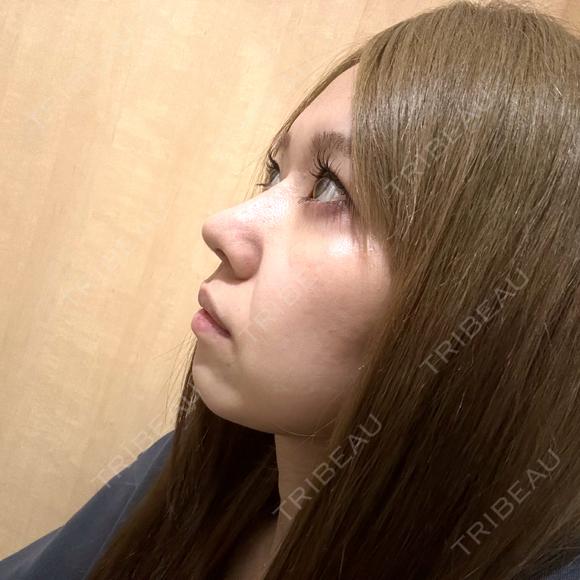 隆鼻術 / 鼻尖形成（切開） / 鼻中隔延長（切開） / 軟骨移植 WOM CLINIC GINZA （ワム クリニック ギンザ） DAY 91 メイン用