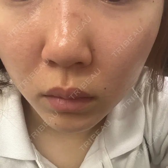 ピーリング（ニキビ・毛穴） / 毛穴洗浄（ハイドラフェイシャルなど） / ポテンツァ Tokyo Tensei Clinic 銀座院 DAY 3 メイン用