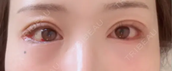 タレ目形成・グラマラスライン（切開） アネシス美容クリニック DAY 3 メイン用