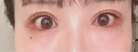 タレ目形成・グラマラスライン（切開） アネシス美容クリニック DAY 4 メイン用