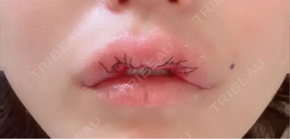 その他（口元） アネシス美容クリニック DAY 3 メイン用